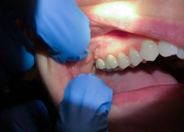 Best Tooth Infection Emergency Dentist  in Mansfield, OH